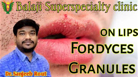 Fordyces Granules On Lips Fordyce Spots By Dr Sanjeeb Rout