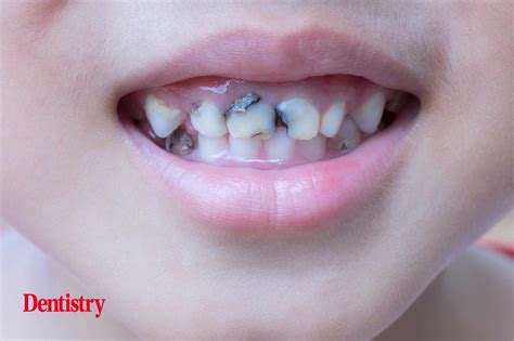 One In 10 Three Year Olds Already Suffer From Tooth Decay Dentistry