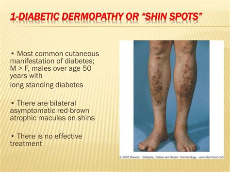 Ppt Cutaneous Manifestation Of Systemic Disease Powerpoint