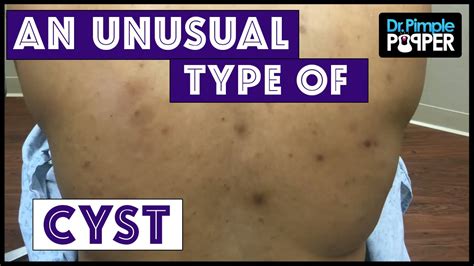 An Unusual Cyst Steatocystoma Multiplex Youtube