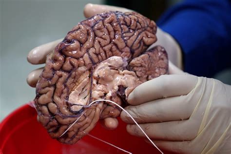 Inside a brain bank, where frozen tubs preserve slices of human tissue ...