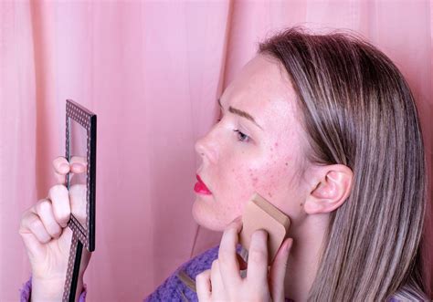 How To Get Rid Of Acne Best Acne Treatment Glowday