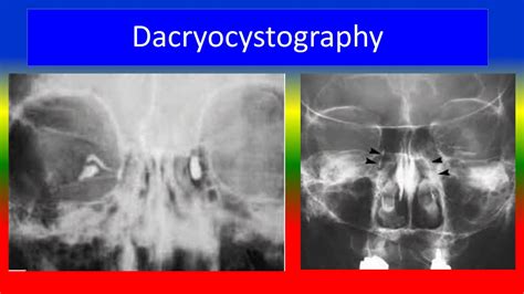 Dacryocystography Youtube