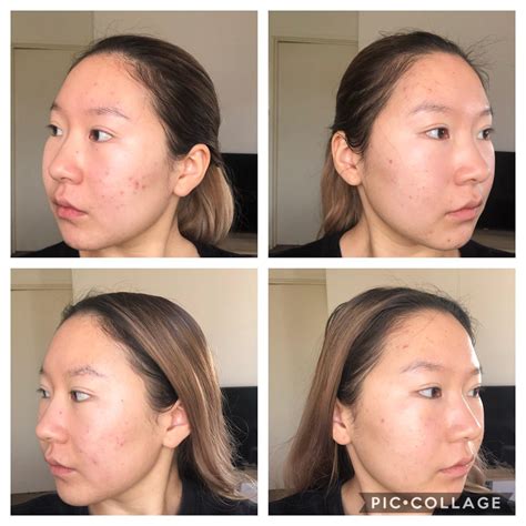 Before And After Chemical Peel For Pie Rtretinoin