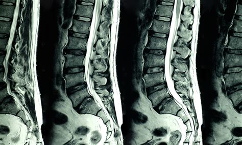 Mri Lower Back Pain