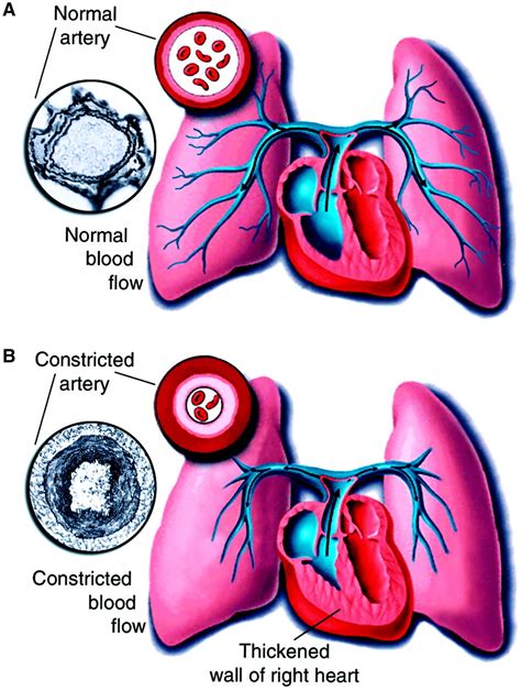 Pulmonary Hypertension Circulation