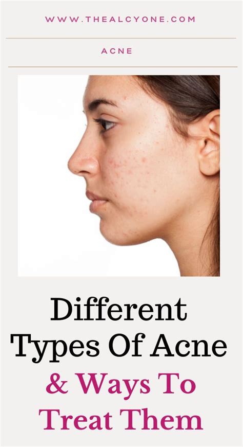 Top 10 Common Cause Of Acne And Treatments Artofit