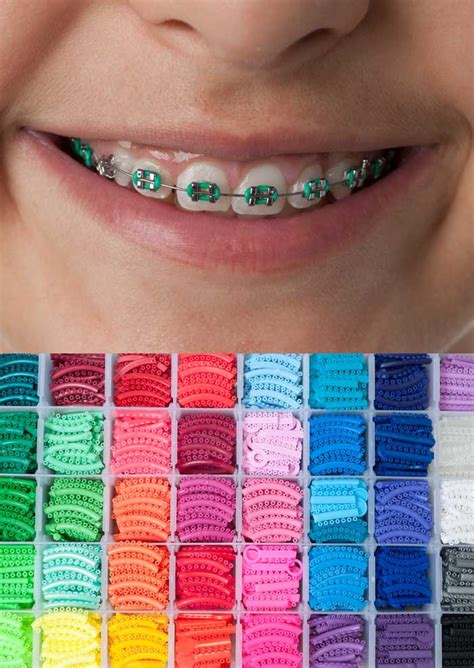 Eating Tips With Braces Braces Colors Dental Cute Combinations Brackets