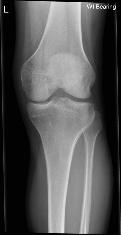Normal Knee Radiology Case