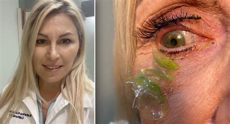 Eye Doctor Finds 23 Contact Lenses Buried In Womans Eye