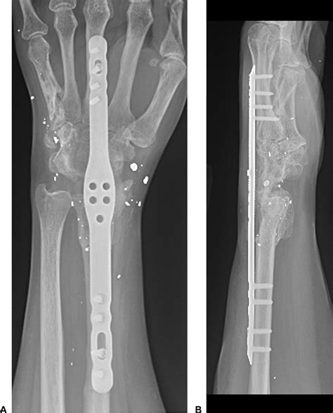 Bone Grafting In Total Wrist Arthrodesis With Large Bone Defects Using
