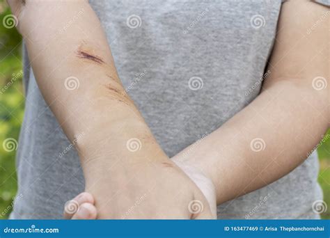 The Wound Form Scabs On Hand And Arm The Wound Happen During Woman