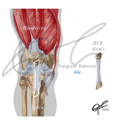 Bone Patellar Bone Graft For Acl Surgery Printable Download Etsy