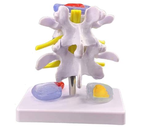 Buy Tjz Human Lumbar Spine Disc Herniation Model Lumbar Spine Model