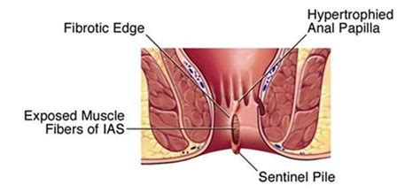 Causes Symptoms And Home Remedies To Cure Anal Fissures