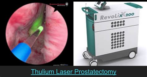 Thulium Laser VapoEnucleation Of The Prostate THULEP Thulium Laser