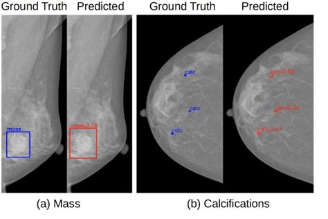 Examples Of Detected A Mass And B Calcification In Mammograms Download Scientific Diagram