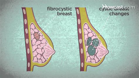 How To Recognize Breast Cancer Symptoms Youtube
