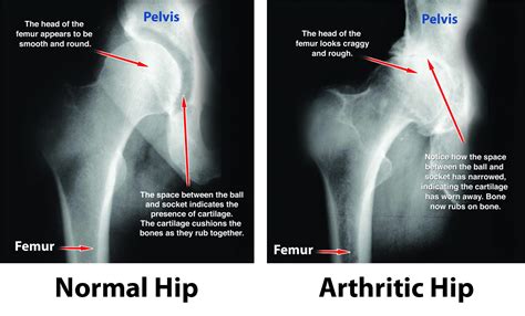 Introducing Hip Resurfacing A Minimally Invasive Alternative To Hip