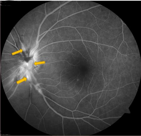 Cureus Idiopathic Retinitis Vasculitis Aneurysms And