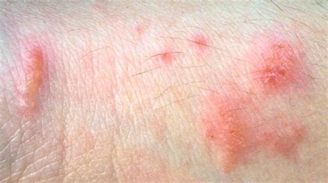 Everything You Need To Know About Poison Ivy Poison Ivy Rash Poison