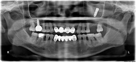 The Initial Panoramic Radiography Showed That The Displacement Of The