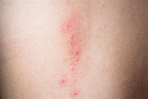 Liver Disease Itchy Skin Rash