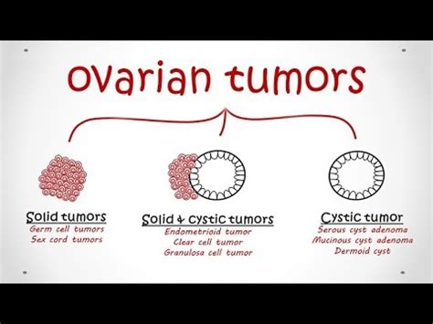 Ovarian Tumors All Types Pathology YouTube