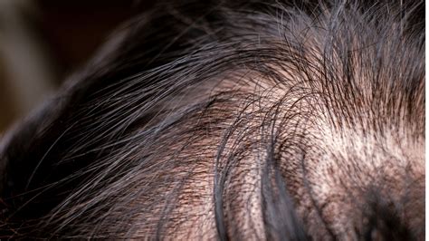 Understanding Hair Loss Causes Diagnosis And Treatment