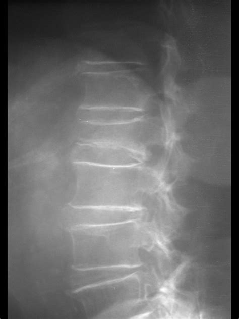 Radiografía Columna Lumbar Osteoporosis Fractura Vertebral Aire Mb