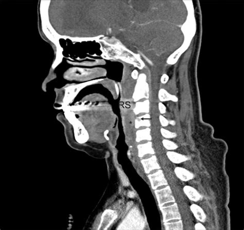 A Ct Of The Neck With Contras Extensive Edema Of The Retropharyngeal