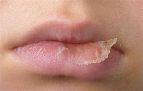 Lip Eczema Triggers And Treatments Seaside Medical Technologies