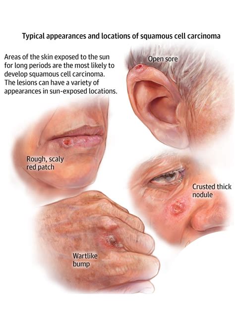 Skin Cancer Symptoms Five Warning Signs Of A Basal Cell Carcinoma Hot
