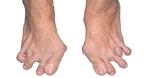 How Rheumatoid Arthritis Affects The Foot And Ankle