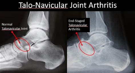 Rheumatoid Arthritis Talonavicular Joint Advanced Footcare