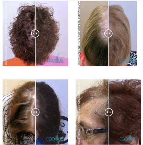 Women Before And After Capillus Hair Loss Treatment Willow Health And Aesthetics