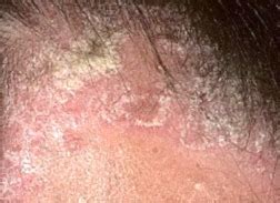 Lihat foto dan kenali gejala, cara mencegah, dan pengobatannya. Penyakit Kulit Psoriasis, Gejala, Penyebab & Cara Mengatasi