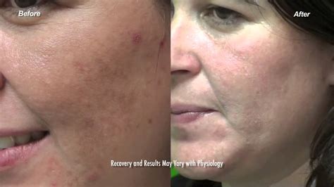 Copy Of Los Angeles Acne Scar Laser Treatment Fraxel Dual Before And