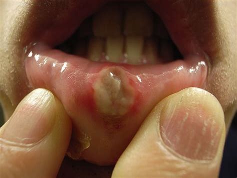 Mouth Sores And Celiac Disease Does Gluten Cause Canker Sores Canker