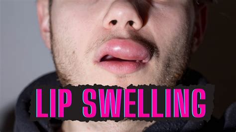 Causes Of Swollen Lips And How To Treat Youtube