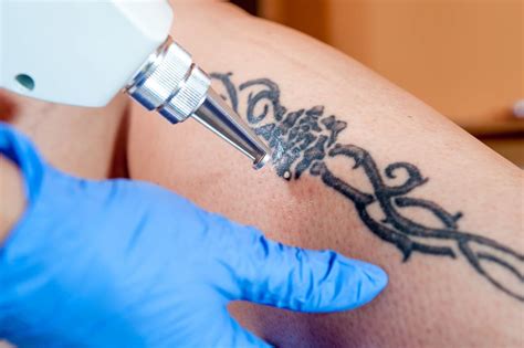 The Naked Truth About Tattoo Removal Monash Lens