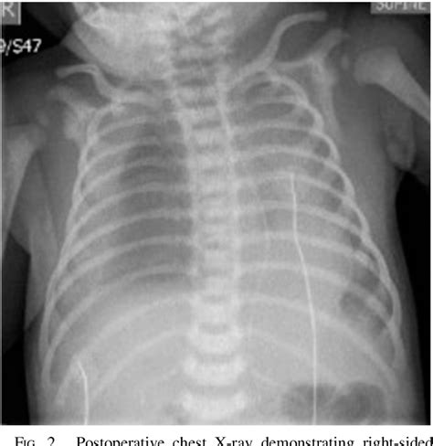 Figure 2 From Contralateral Chylothorax After Congenital Diaphragmatic