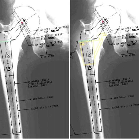 Depuy S Rom® Modular Hip System 4 Download Scientific Diagram