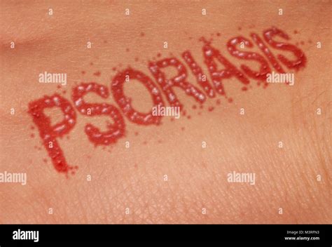Psoriasis Autoimmune Disease As Dry Red Skin Patches As A Symbol For