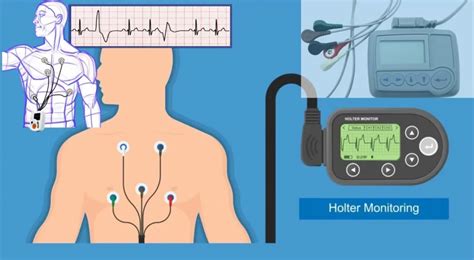 What Is The Holter Monitor Working Principle Best Uses And Types 24