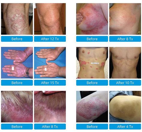 Psoriasis In Brooklyn Ny Dr Ghatan Dermatology Cosmetic And Laser