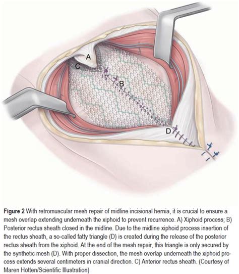 Incisional Hernia Ultrasound