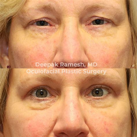 Blepharoplasty In New Jersey Eyelid Surgery In New Jersey