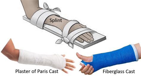 Fracture Casts And Splints