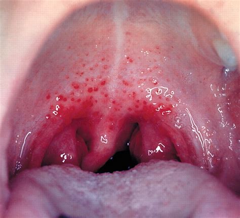 Invasive Group A Streptococcal Infections Cmaj